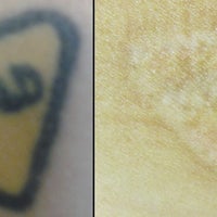 Vanish Laser Tattoo Removal and Skin Aesthetics ...