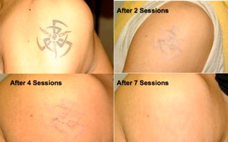 clear out ink laser tattoo removal prices photos u0026 reviews clear out ink laser tattoo removal prices photos u0026 reviews